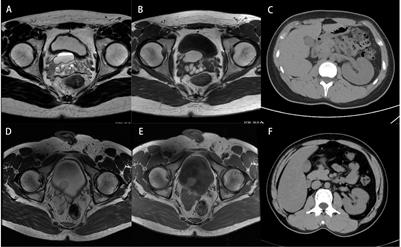 Clinicopathological and genetic features of Zinner’s syndrome: two case reports and review of the literature